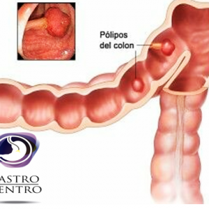 pólipos de colon