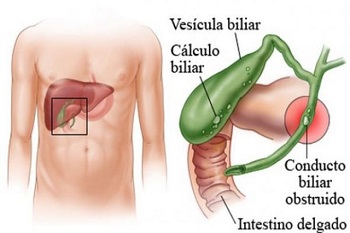 Cirugía de vesícula por cálculos