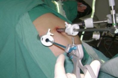 ¿La laparoscopia es igual que la cirugía láser?