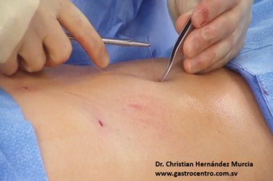 Cirugía de Vesícula por Cálculos