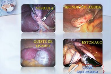 ¿Qué cirugías se pueden realizar por medio de la laparoscopia?