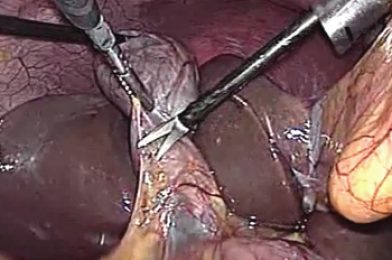 Cirugía laparoscópica de la vesícula biliar